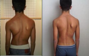 Child with scoliosis