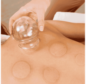 Practitioner placing cups on a patient's back